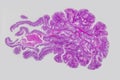 Colon polyp